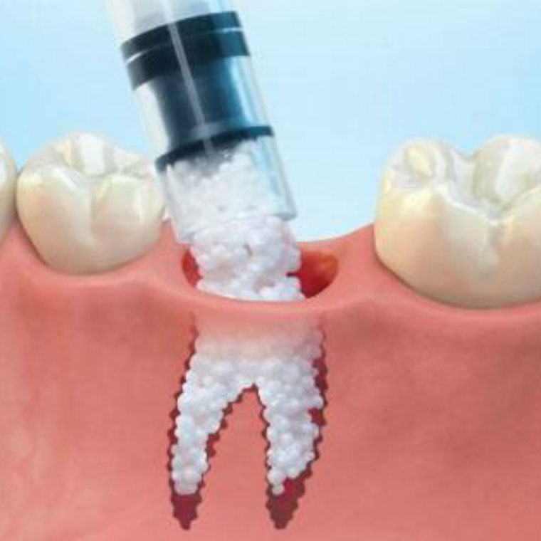 Grefarea osoasă dentara, sinus lifting osos