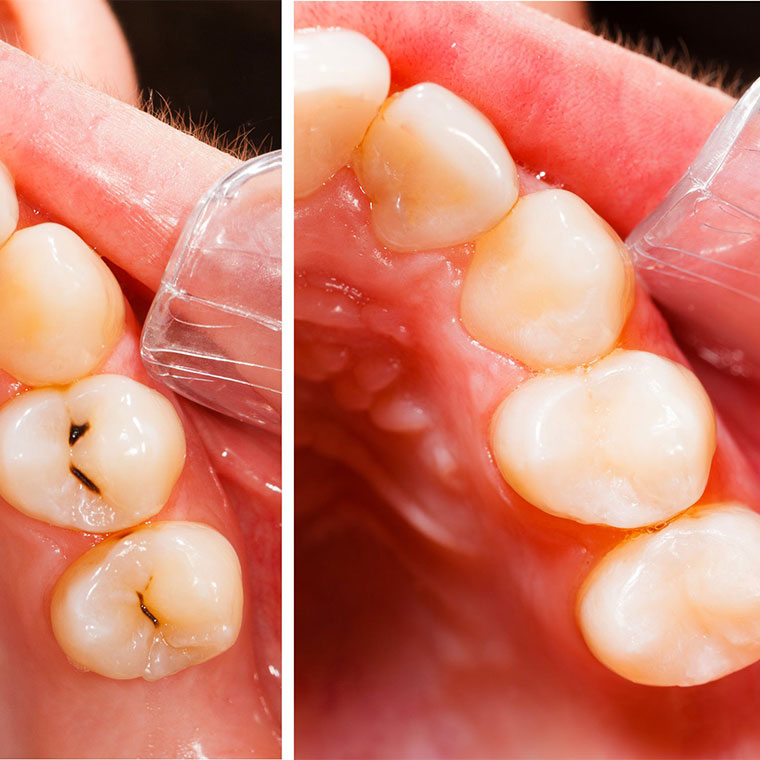 Tratarea cariilor dentare