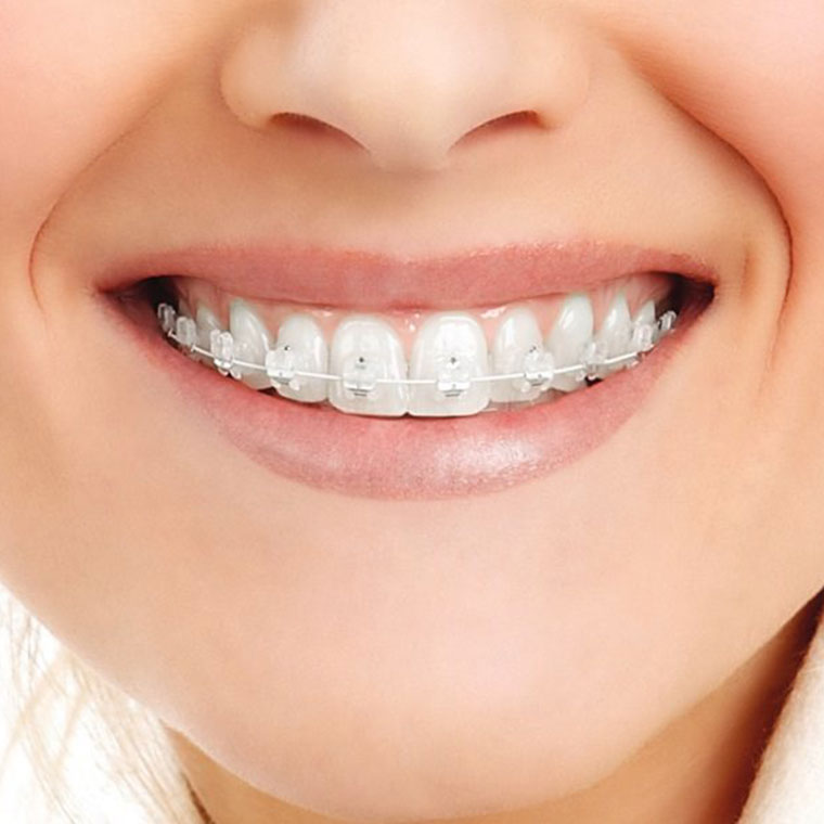 Bretele dentare