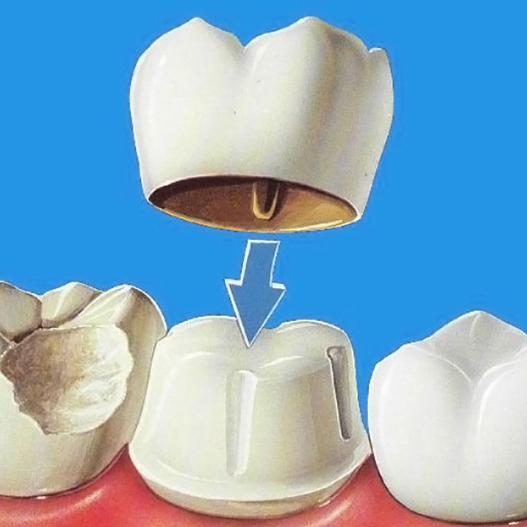 Coroană metalo-ceramică