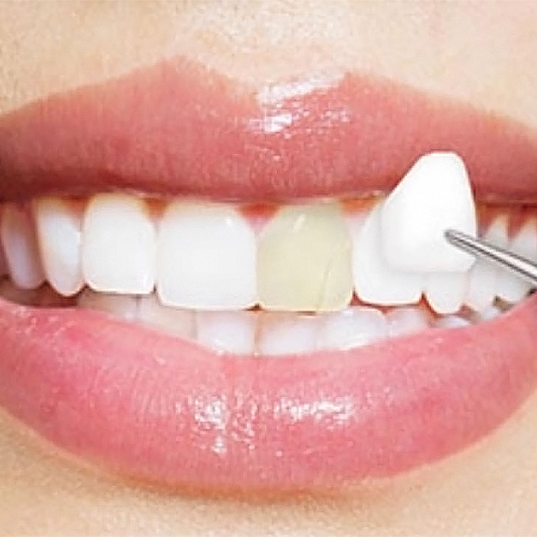 Faţete dentare