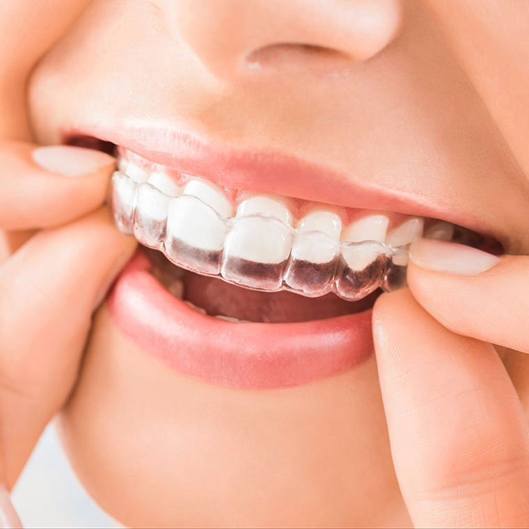 Aparatul dentar Invisalign